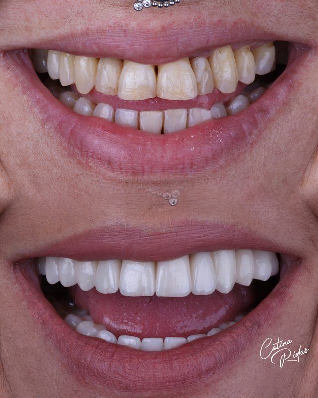 Transformación sonrisa composite Málaga caso