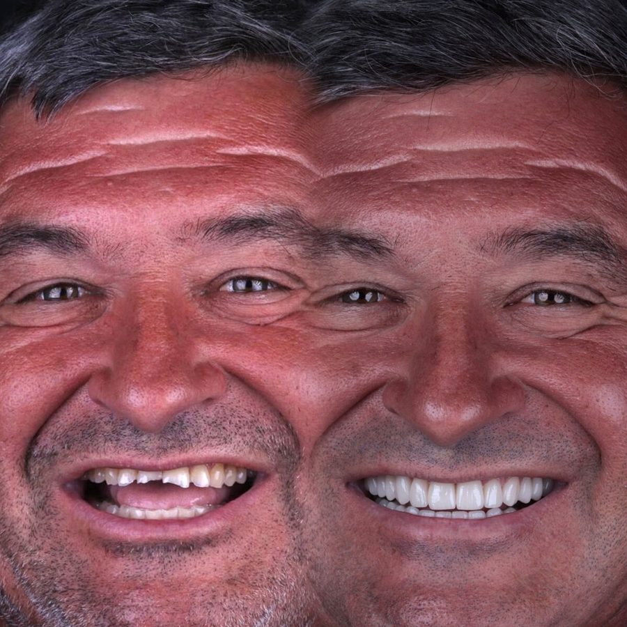 Carillas de porcelana en Málaga, resultado final (caso 1)