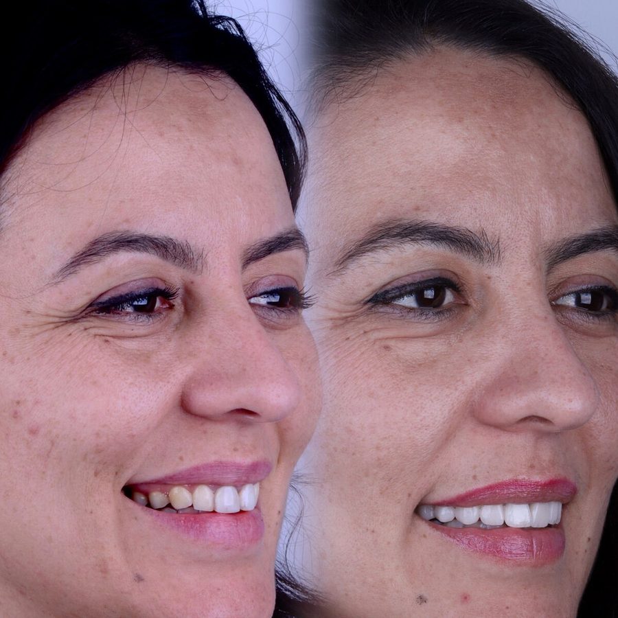 Carillas de porcelana en Málaga, transformación completa de la sonrisa (caso 5)