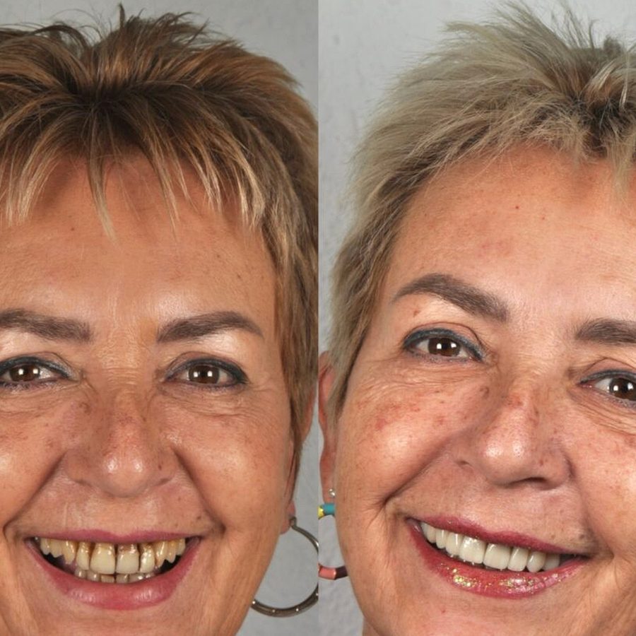 Carillas de porcelana en Málaga, transformación completa de la sonrisa (caso 12)