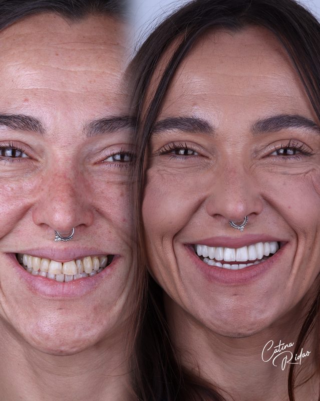 Carillas cerámica mujer piercing antes después Málaga