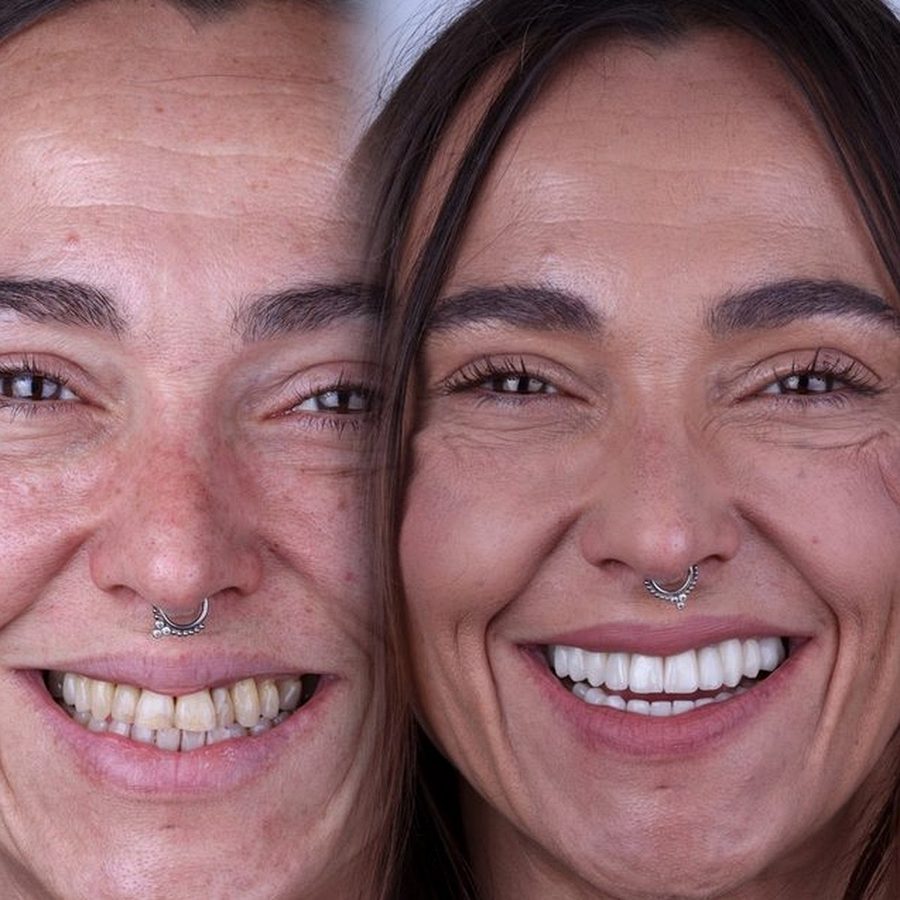 Carillas de porcelana en Málaga, transformación completa de la sonrisa (caso 11)