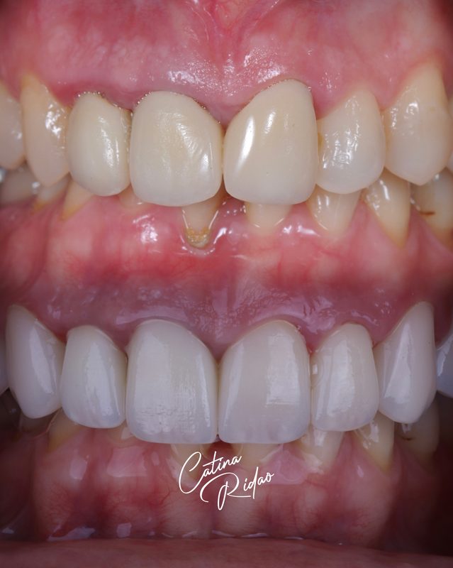 Carillas cerámica dientes resultado Málaga caso