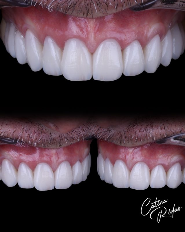 Rehabilitación cerámica dientes antes después Málaga hombre