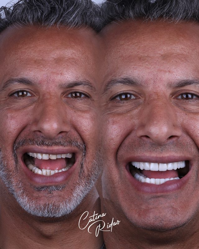 Transformación sonrisa cerámica hombre cara Málaga