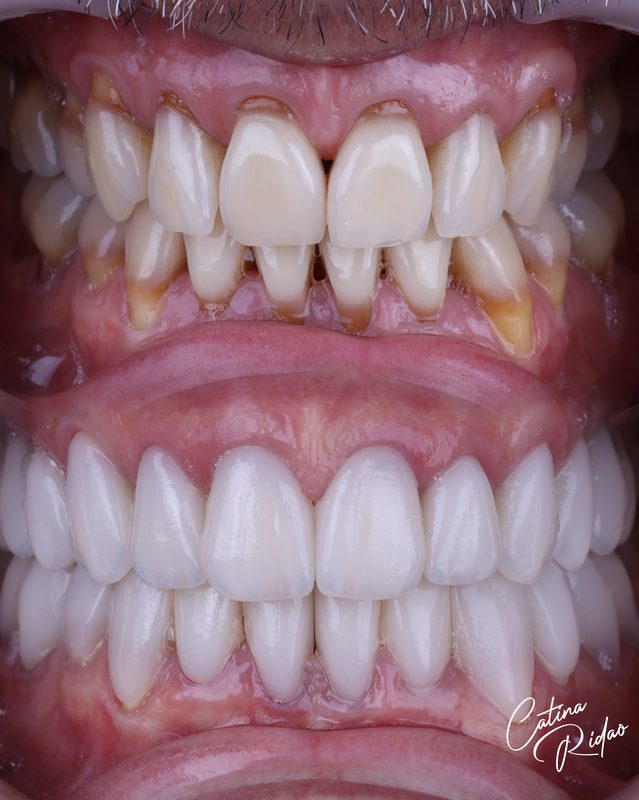 Carillas cerámica dientes resultado hombre Málaga