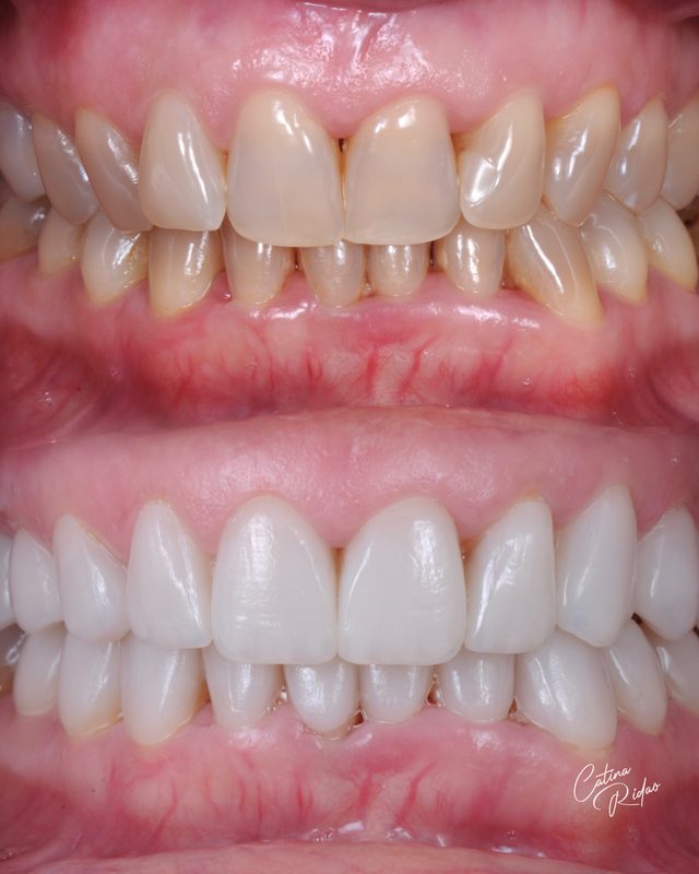 Cerámica antes después dientes mujer Málaga caso real