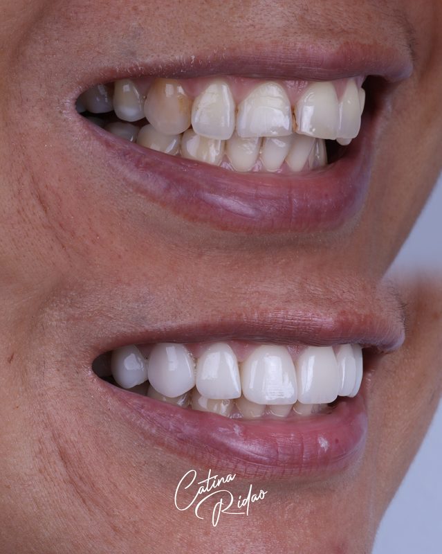 Carillas cerámica Málaga transformación sonrisa antes después