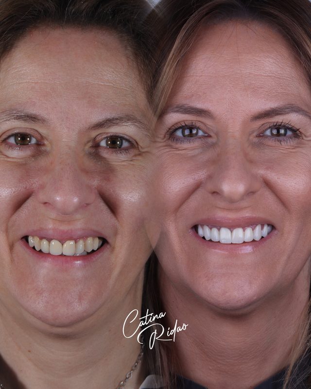 Transformación sonrisa cerámica mujer Málaga antes después