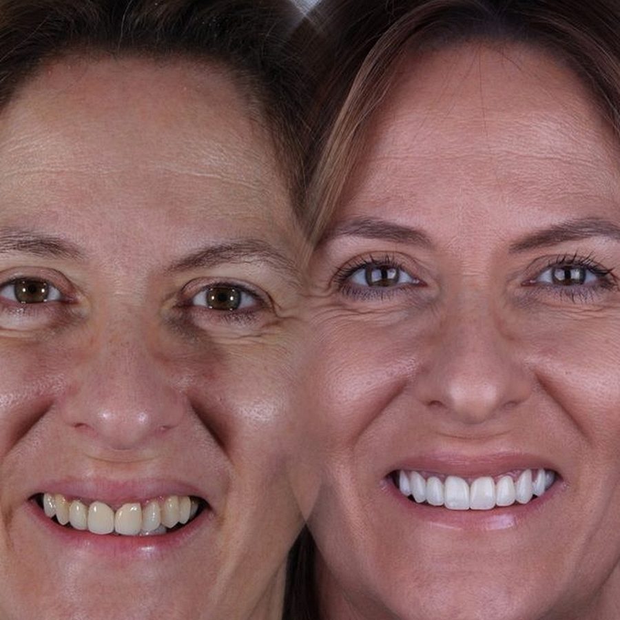 Carillas de porcelana en Málaga, transformación completa de la sonrisa (caso 13)