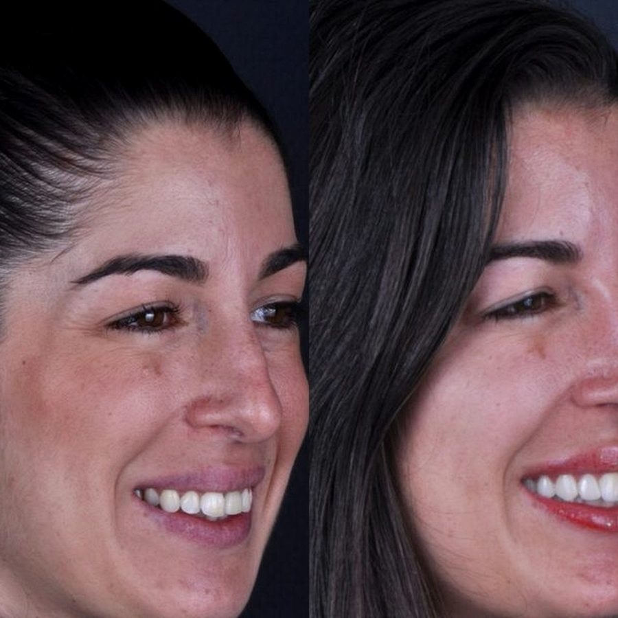 Carillas de porcelana en Málaga, antes y después (caso 23)