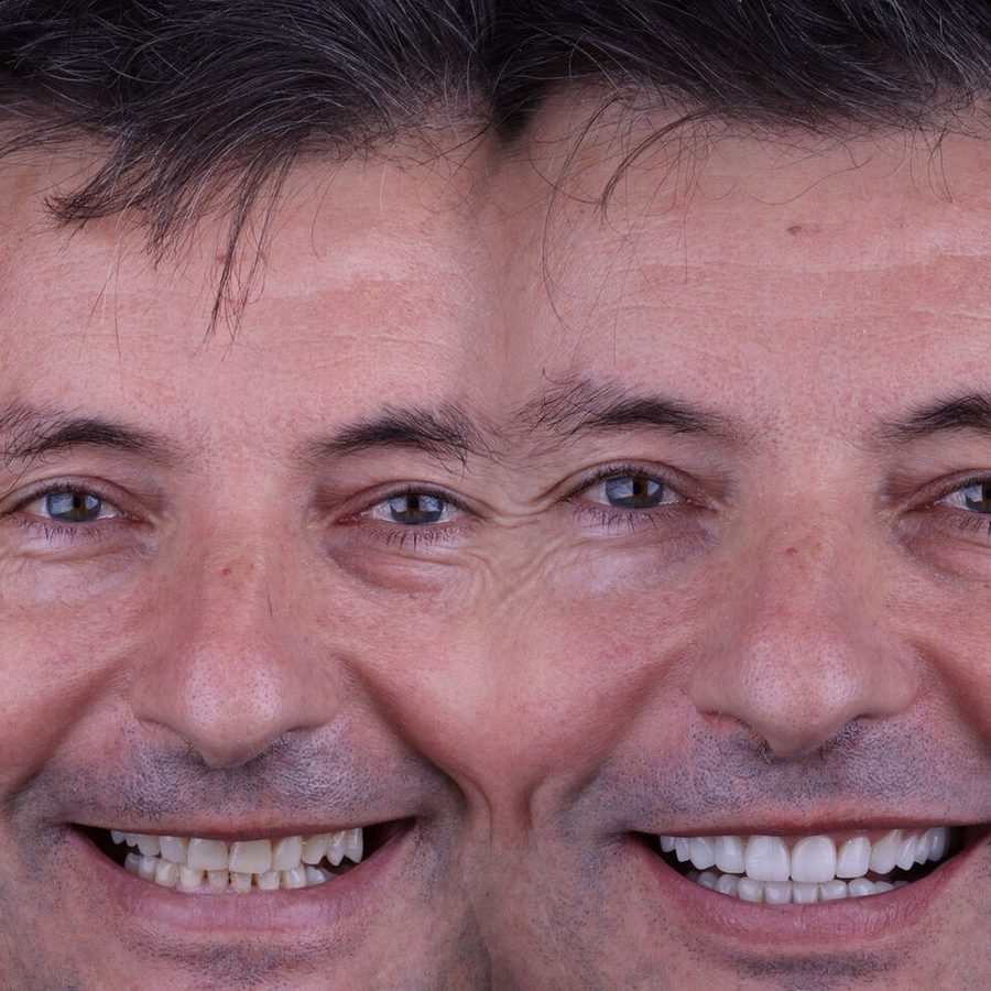 Carillas de porcelana en Málaga, transformación completa de la sonrisa (caso 21)