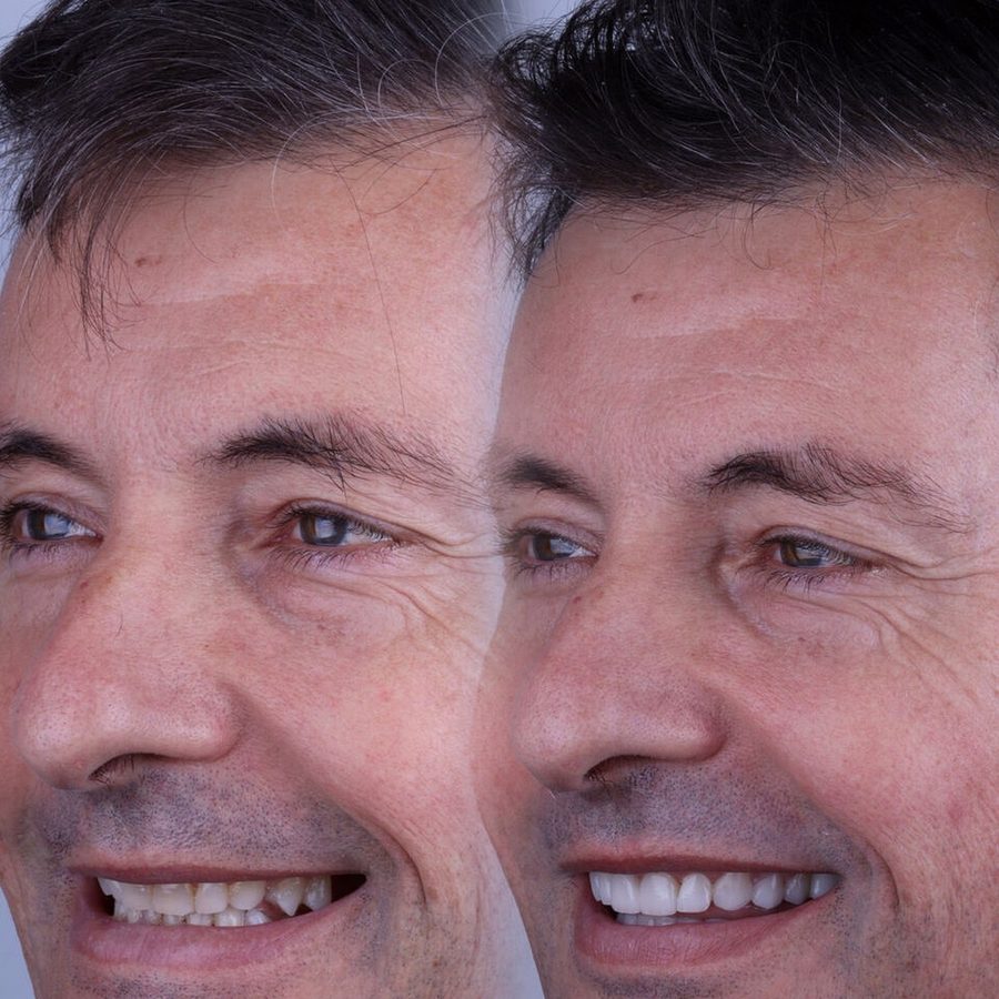 Carillas de porcelana en Málaga, antes y después (caso 20)