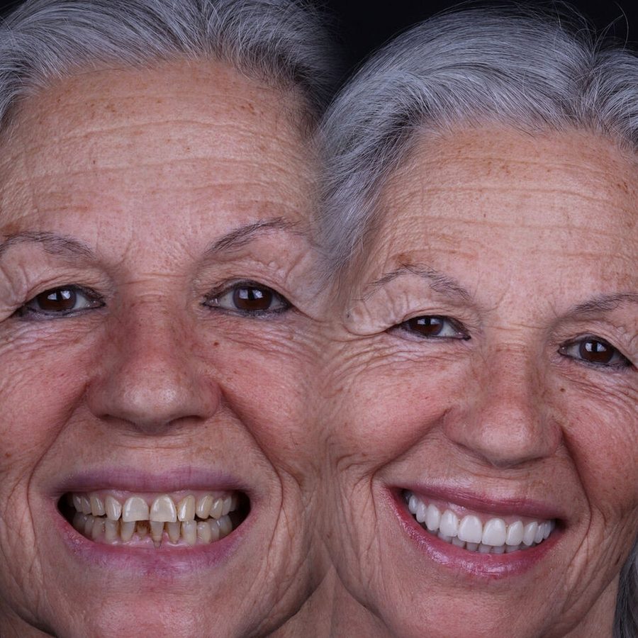 Carillas de porcelana en Málaga, transformación completa de la sonrisa (caso 7)