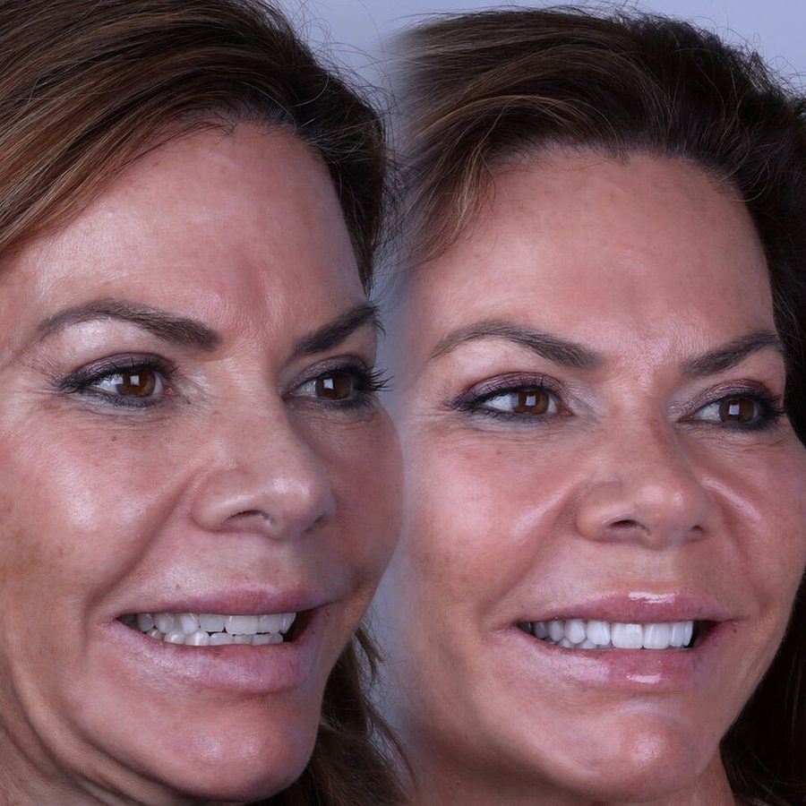 Carillas de porcelana en Málaga, antes y después (caso 25)