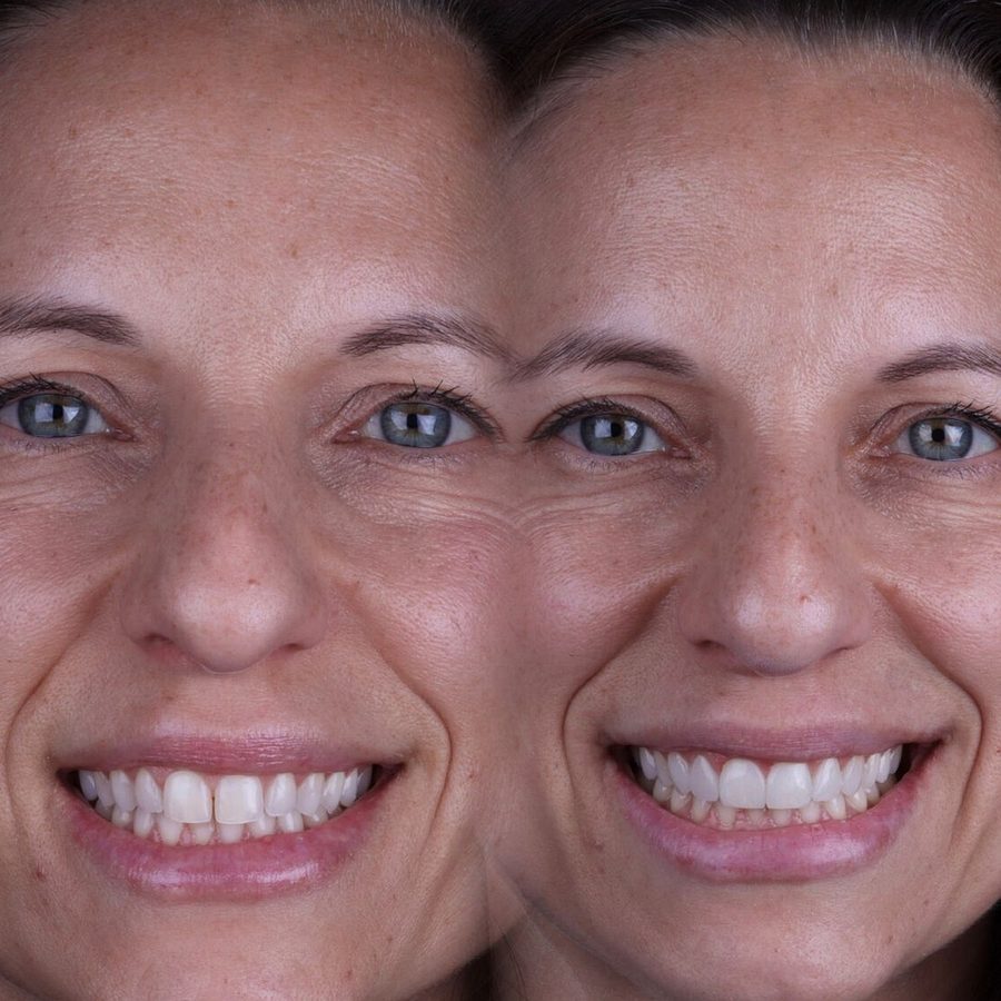 Carillas de composite en Málaga, transformación completa de la sonrisa (caso 1)
