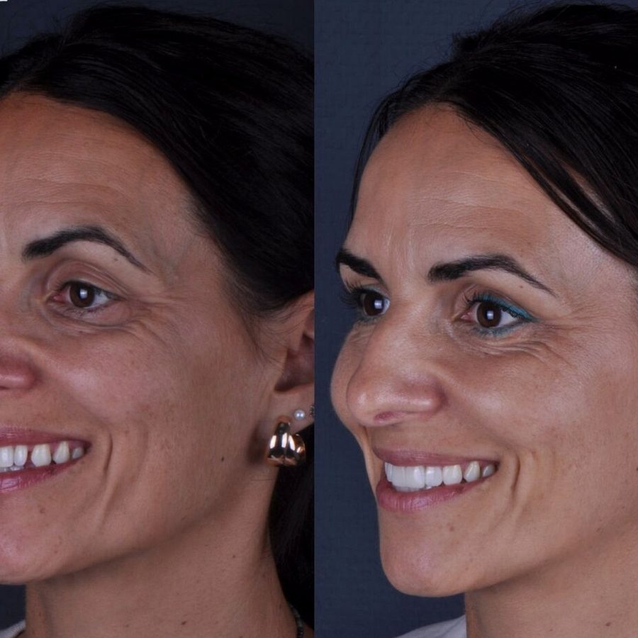 Carillas de composite en Málaga, antes y después (caso 23)