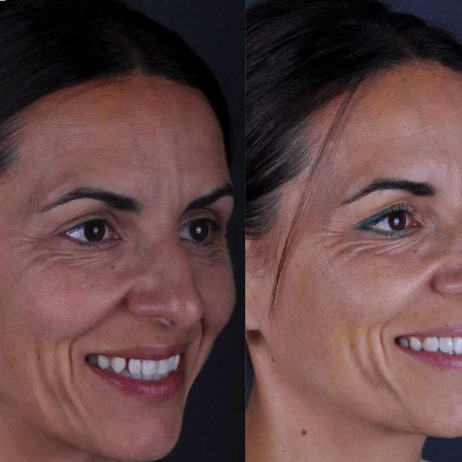 Carillas de composite en Málaga, transformación completa de la sonrisa (caso 20)