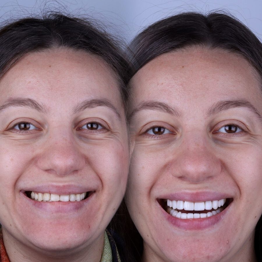 Carillas de composite en Málaga, transformación completa de la sonrisa (caso 2)