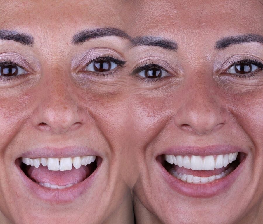 Carillas de composite en Málaga, antes y después (caso 18)