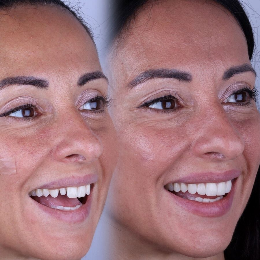 Carillas de composite en Málaga, transformación completa de la sonrisa (caso 19)