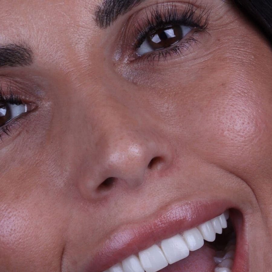 Carillas de composite en Málaga, transformación completa de la sonrisa (caso 16)