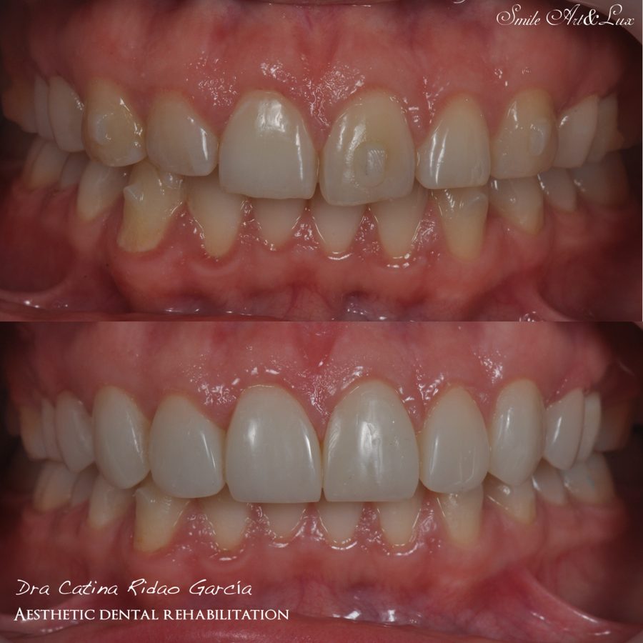 Carillas de composite antes y después, sonrisa frontal