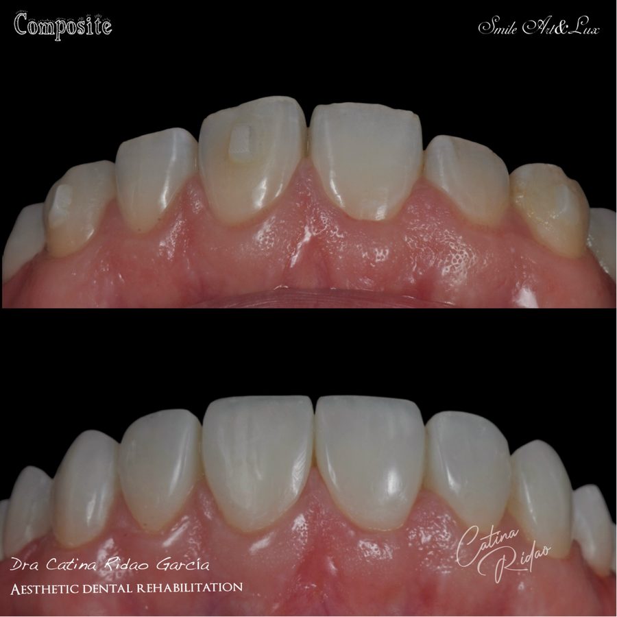Carillas de composite antes y después, forma y color
