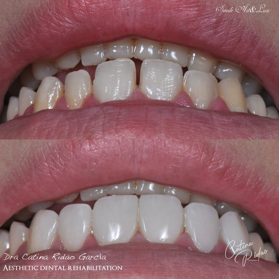 Carillas de composite antes y después, apiñamiento leve
