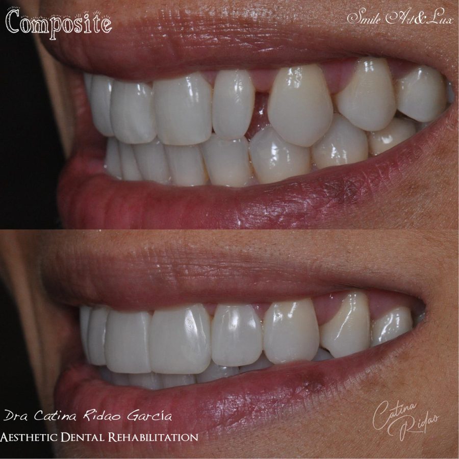 Carillas de composite antes y después, sonrisa lateral