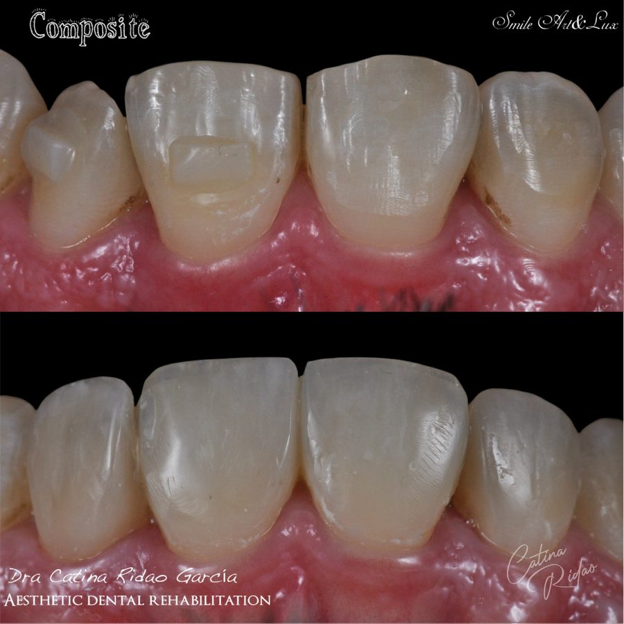 Carillas de composite antes y después, estratificación