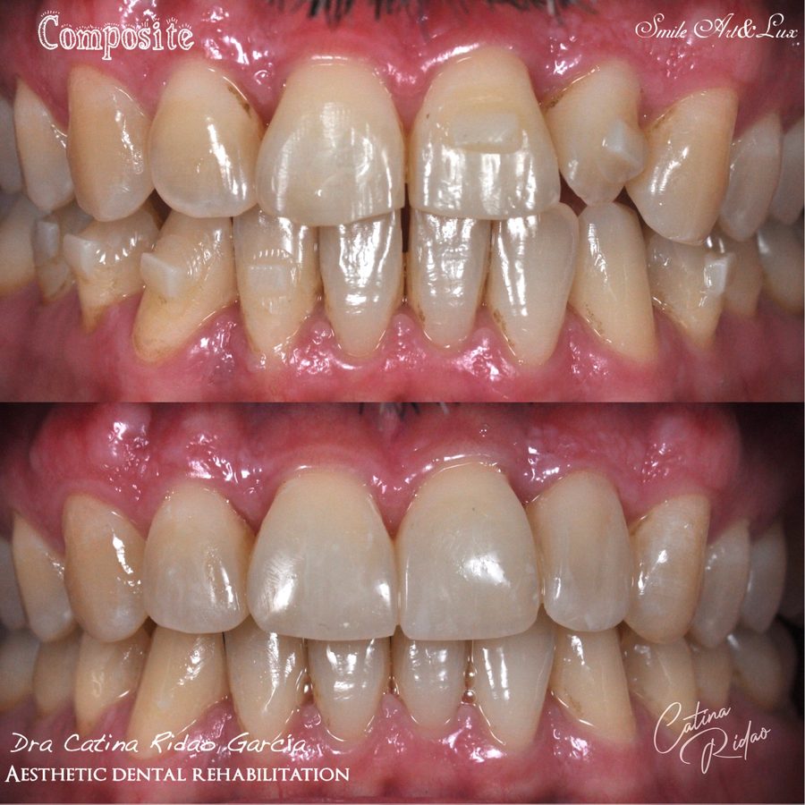 Carillas de composite antes y después, tinciones corregidas