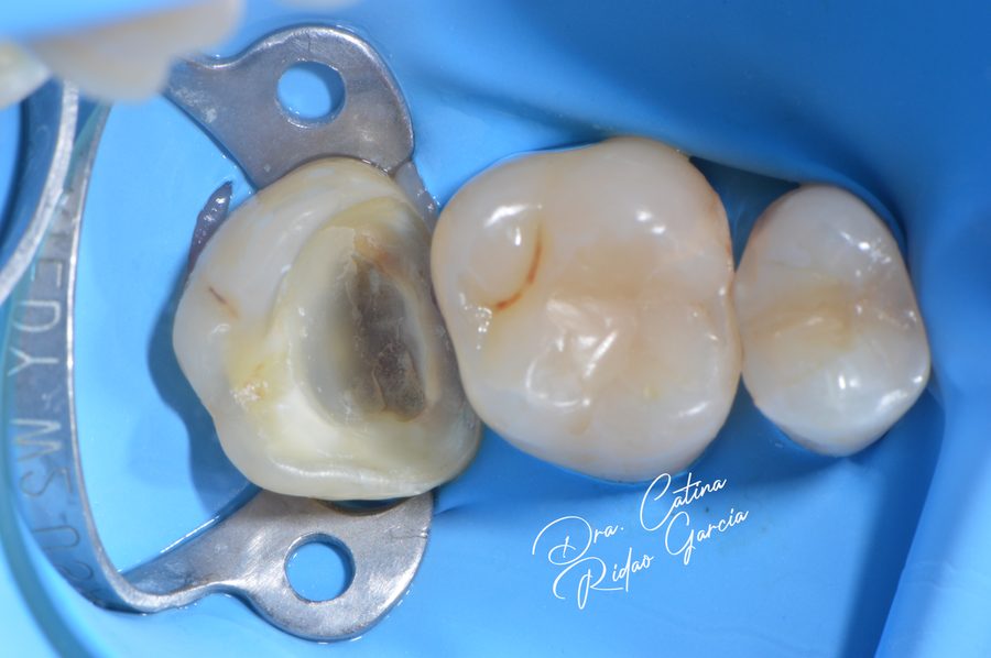 Caries tratada con aislamiento absoluto mediante dique de goma