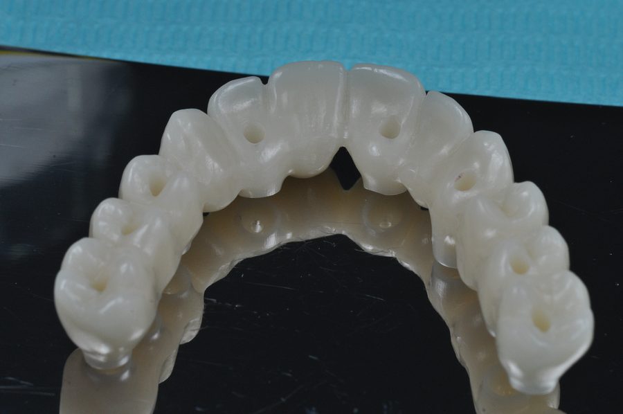 Prótesis de zirconio sobre implantes, vista oclusal