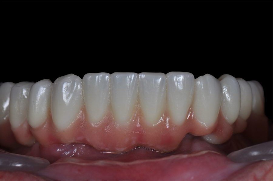 Rehabilitación sobre implantes, resultado final