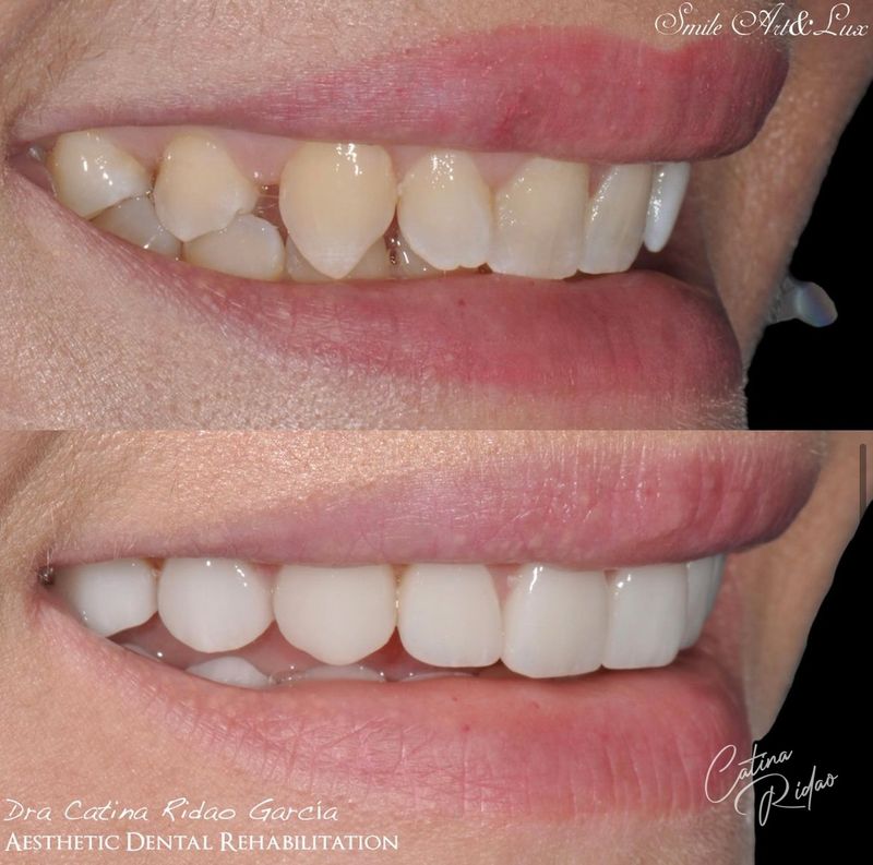 Carillas composite cerámica Málaga resultado labios