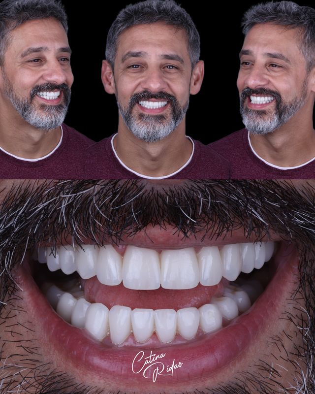 Antes después carillas cerámica Málaga hombre