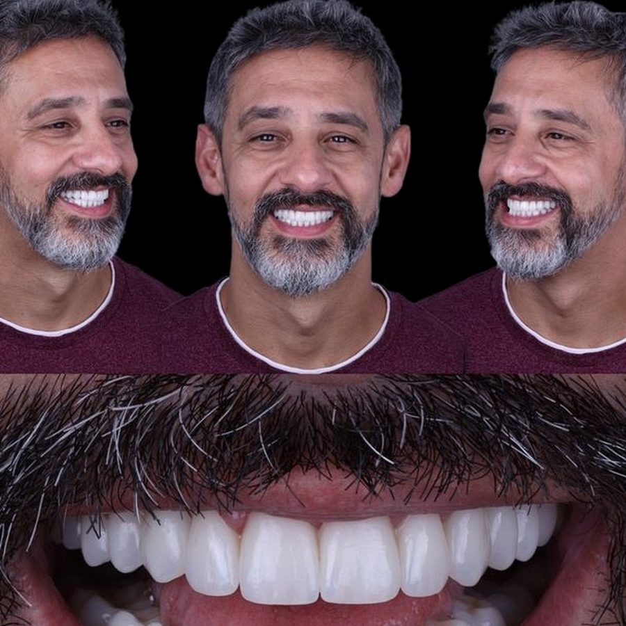Carillas de porcelana en Málaga, transformación completa de la sonrisa (caso 14)