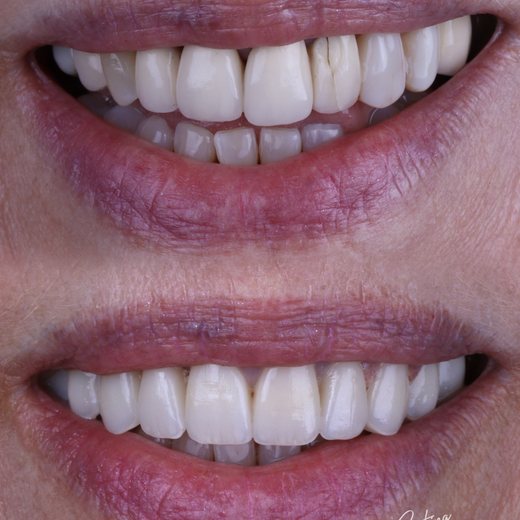 Rehabilitación sonrisa Málaga antes después