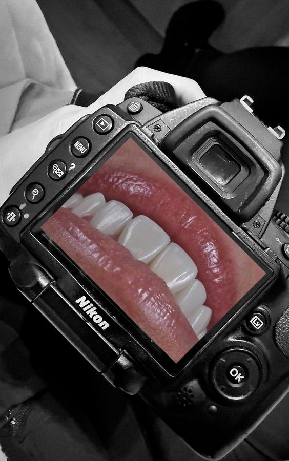 Detalle de una sonrisa tras el tratamiento, fotografía dental artística