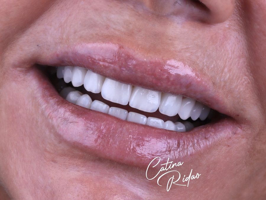 Sonrisa natural en primer plano tras carillas dentales