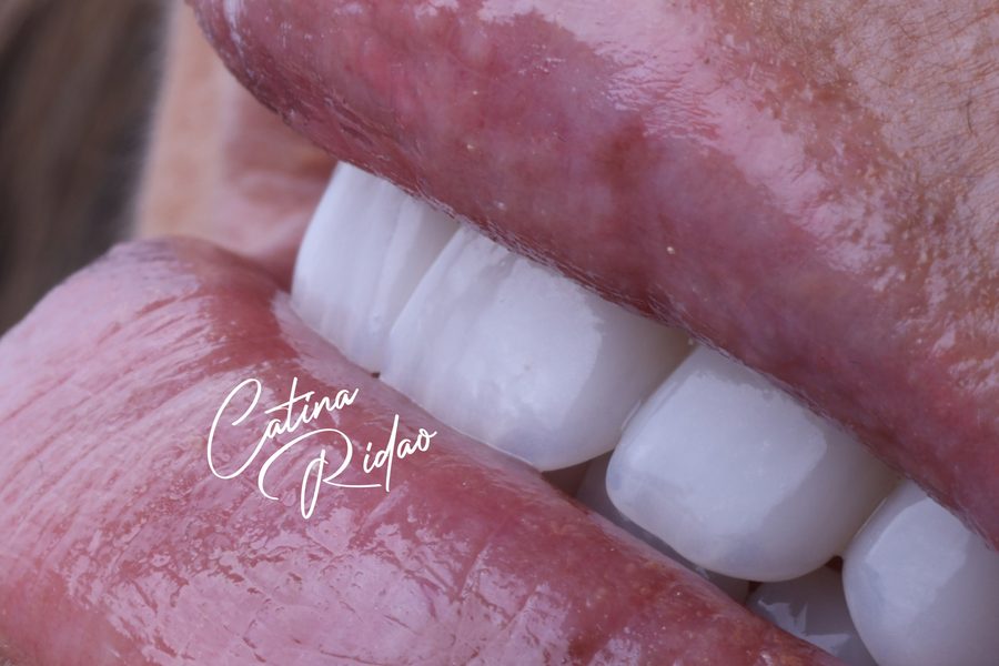 Detalle del borde incisal de las carillas de porcelana