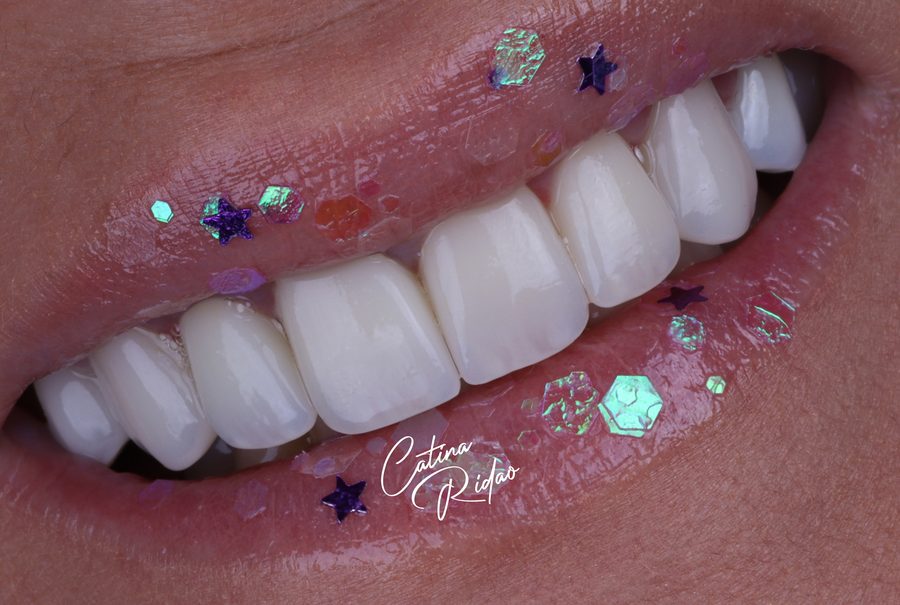 Sonrisa con brillos y purpurina, macro dental artística