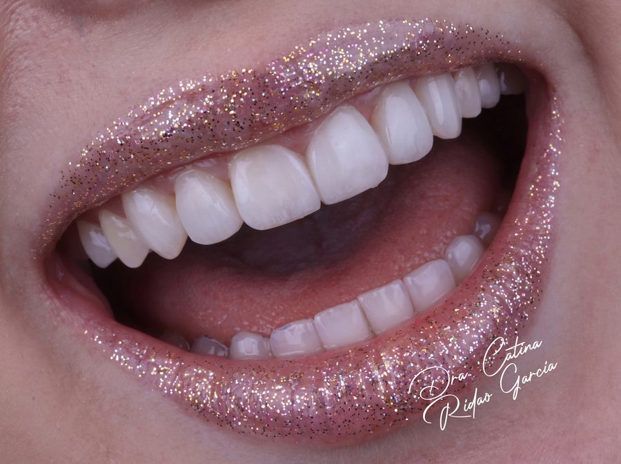 Sonrisa abierta en primer plano, fotografía dental artística