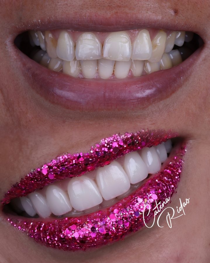 Labios con purpurina fucsia, macro dental artística en Málaga