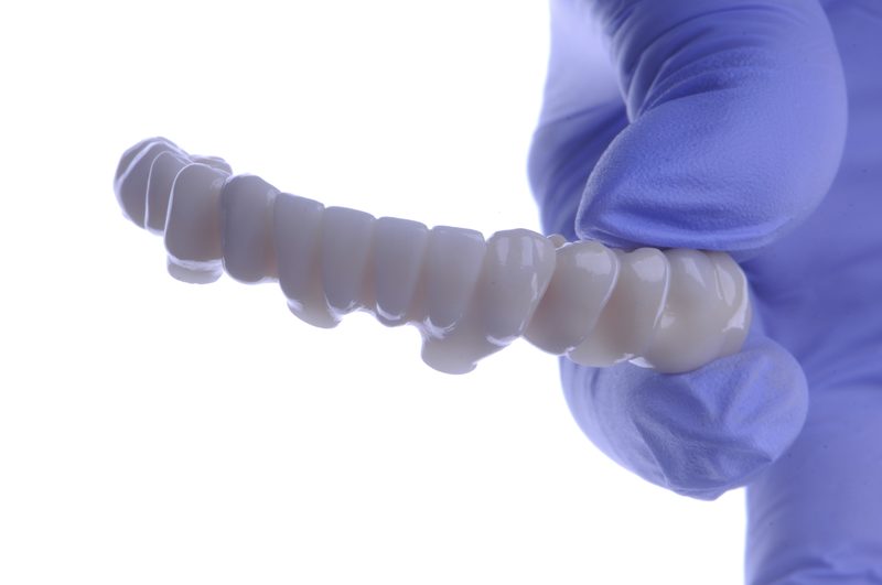 Prótesis cerámica sobre implantes lateral Málaga