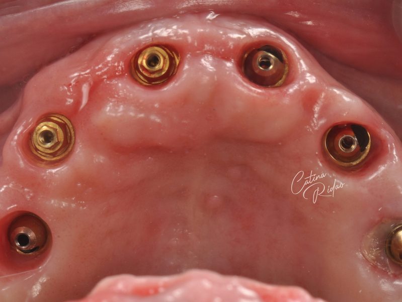 Implantes dentales integrados arcada Málaga antes prótesis