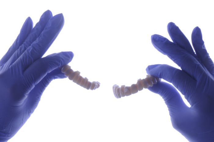 Pilares implantes dentales Málaga rehabilitación completa
