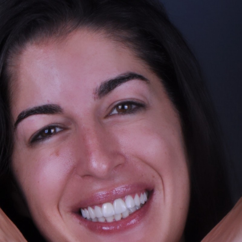 Diseño de sonrisa DSD Málaga