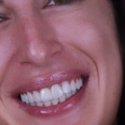 Diseño de sonrisa DSD Málaga